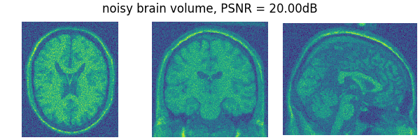 noisy brain volume, PSNR = 20.00dB