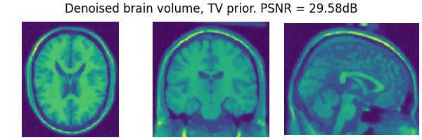 Denoised brain volume, TV prior. PSNR = 29.58dB