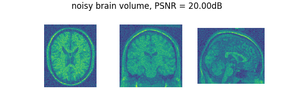 noisy brain volume, PSNR = 20.00dB